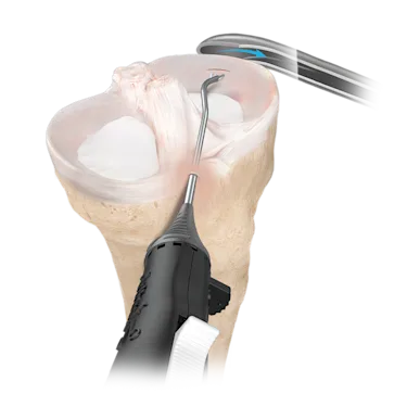 Arthrex - ZoneNavigator, Left Middle / Posterior Cannula